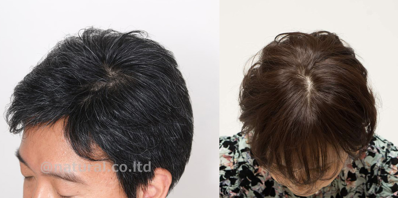 ウィッグの生え際写真